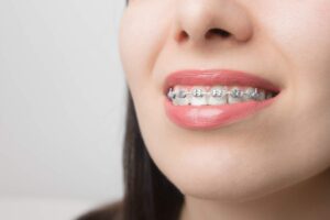 young-woman-smile-with-dental-braces-brackets-on-2021-10-12-23-20-05-utc - Dente .COM